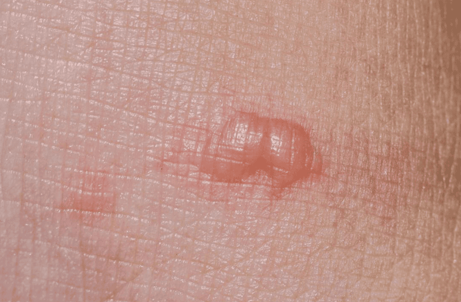 fever_cat-bartonella henselae